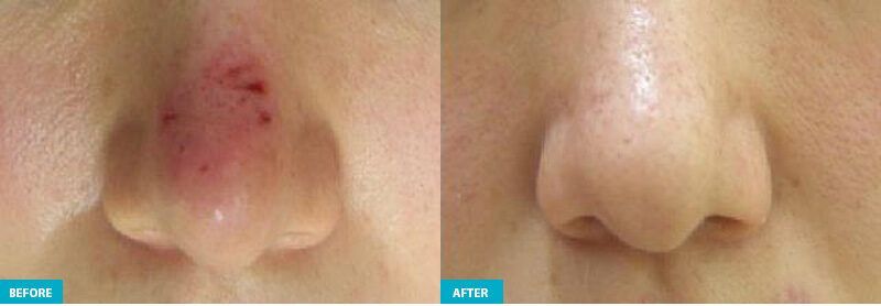 healite ii before and after