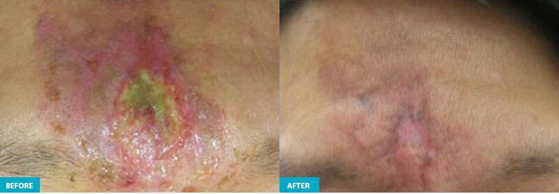 Princeton Junction healite ii before and after face