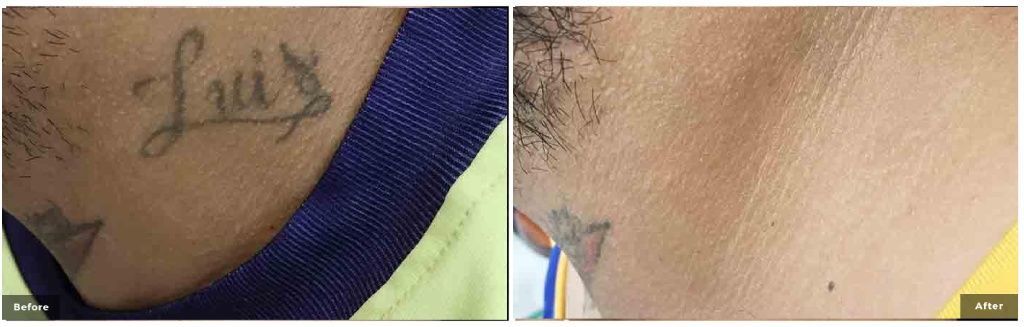 Princeton Junction tattoo removal before and after