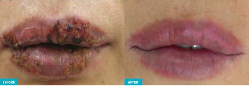Princeton Junction healite ii before and after lips