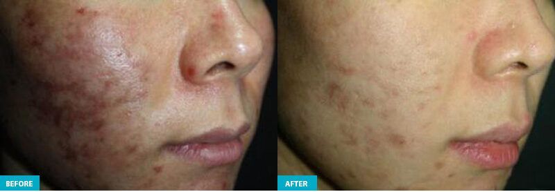 healite ii before and after