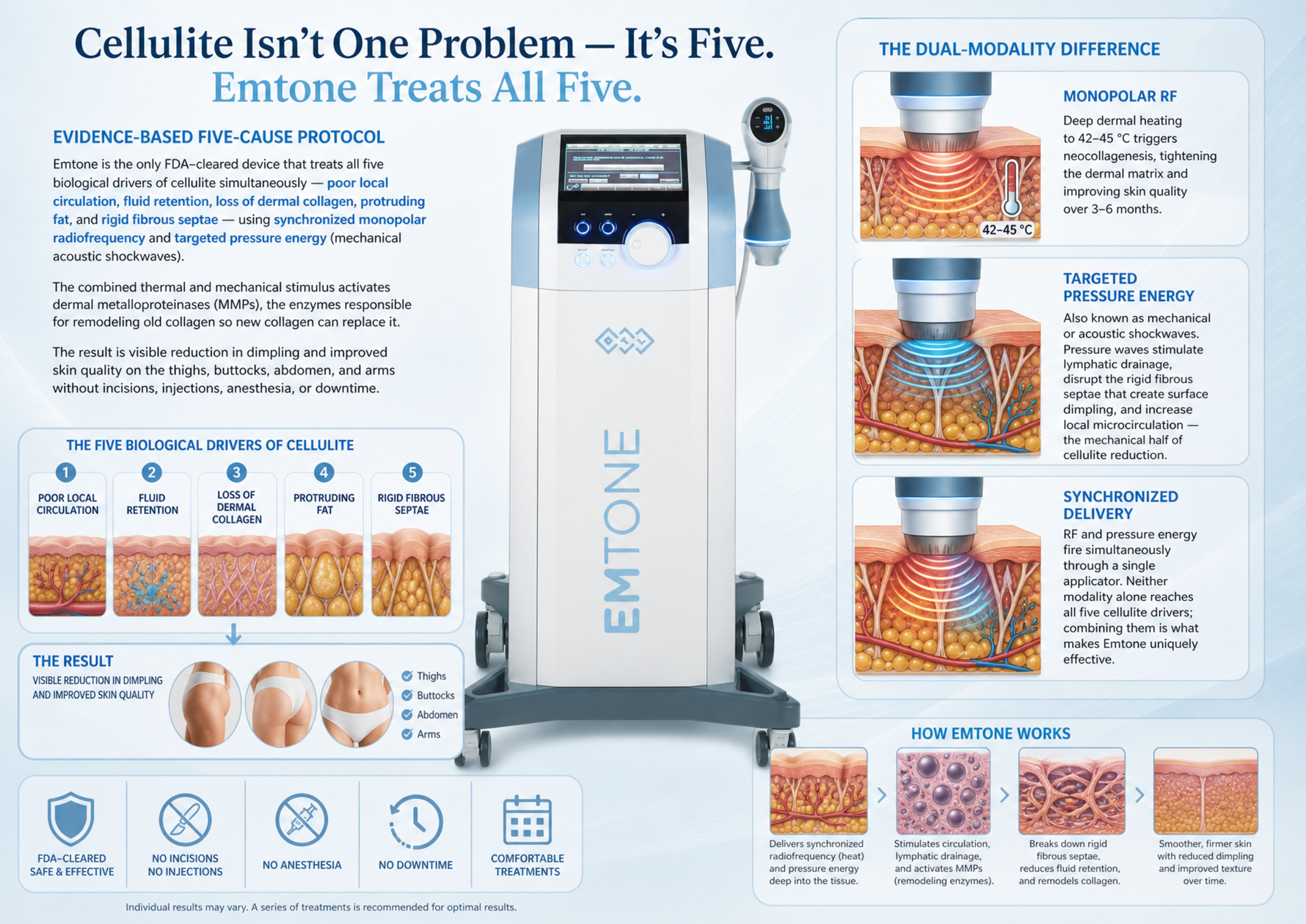 Emtone infographic — five biological drivers of cellulite treated by synchronized monopolar radiofrequency and targeted pressure energy